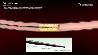 NAVICROSS Telescoping Video  | Terumo Interventional Systems