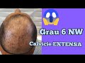 Transplante Capilar FUE Grau 6