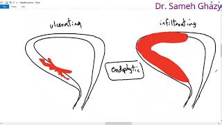 systemic pathology 55 :Urinary system 9  ( tumors of urinary bladder)  سرطان المثانة DR. SAMEH GHAZY