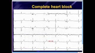 EMRAP TV 128 Are Those P Waves?