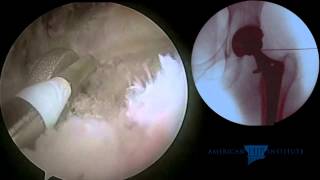 Hip Arthroscopy: Total Hip Replacement - Iliopsoas Tendon Release for Impingement on a Collared Stem