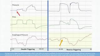 Reverse Triggering vs Double Triggering in Ventilator Dyssynchrony