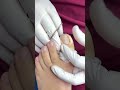 matricectomia química ingrown_toenail_surgery satisfying podologo