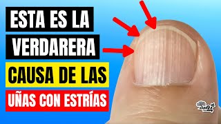 🔴 ¿Porque tengo UÑAS con ESTRÍAS? ¡Esta es la verdadera CAUSA! Tu cuerpo te HABLA