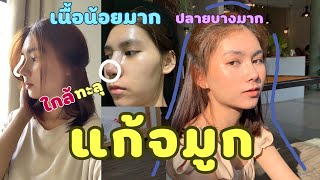 รีวิวแก้จมูก , ทำจมูกครั้งแรก ,จมูกเนื้อน้อยมาก , ปลายจมูกบาง