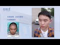 fue植髮的效果究竟如何？大陸髪友術後效果公開曝光！yonghe hair transplant