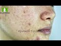 turmeric face pack for skin whitening oily skin dry skin how to remove pimples overnight