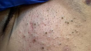Soko Korean Skincare Routine (For Facial Care, Acne, And Blackheads)