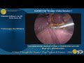 total laparoscopic excision of type 1 choledochal cyst with roux en y reconstruction.