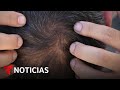 La FDA aprueba un medicamento contra la alopecia | Noticias Telemundo