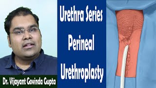 Surgery for Urethral Stricture (Technique 3) - Perineal Urethrostomy