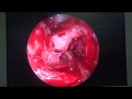 Prominent PEA ( Posterior ethmoidal artery ) - FESS Unedited ( Case 9 ) - Dr. Satish jain