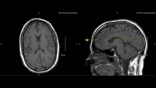 Unremarkable Non-Contrast Brain MRI: Axial T1- Example 1