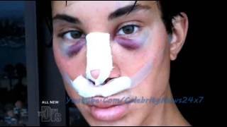 Justin Jedlica plastic surgery before and after