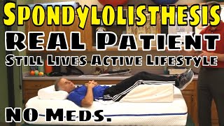 Spondylolisthesis, Real Patient Still Lives Active Lifestyle- No Meds.