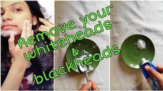 Easy way to remove Blackheads and Whiteheads | බ්ලැක්හෙඩ්ස් සහ වයිට්හෙඩ්ස්