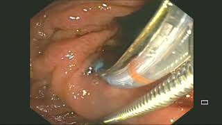 Biopsy assisted common bile duct cannulation