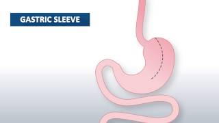What is gastric sleeve surgery? | Beaumont Health