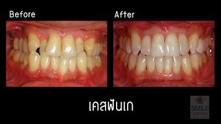 จัดฟันใส invisalign เคสฟันซ้อนเก เด็นทัลดีไซน์เซ็นเตอร์ พัทยา / สไมล์เซ็นทรัลเวสเกต บางใหญ่