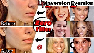 Botox Lip Flip Before and Afters | Everything you NEED to Know