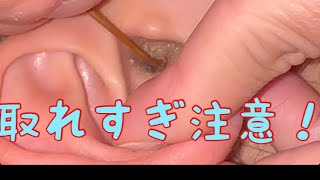 【耳掃除】チャンネル登録5000人いきました！ありがとうございます【耳かき】【Ear Wax】