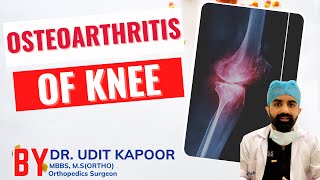 OsteoArthritis of Knee | By Dr. Udit Kapoor | Orthopedics Surgeon