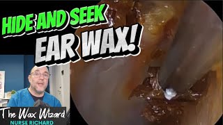 HIDE \u0026 SEEK EAR WAX! 407 #ear #earwax #earwaxremoval #asmr #satisfying #foryou #fyp #foryourpage