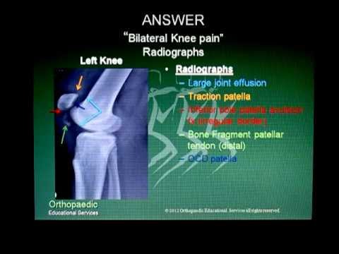 Bilateral Knee Pain - YouTube