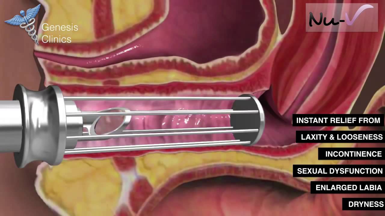 Nu-V Non Surgical Vaginaplasty And Labiaplasty - YouTube