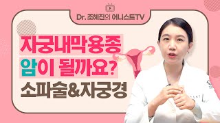 자궁내막용종(폴립), 암이 될 수 있을까요?😨 | 소파술, 자궁경, 불임/난임