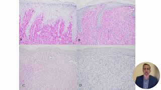 Xanthogranuloma NGS study ASDP presentation