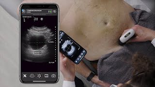 Scanning The Bladder