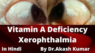 विटामिन A की कमी के लक्षण, कारण और उपचार # Vitamin A deficiency symptoms, causes and treatment