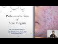 Patho-mechanism of Acne Vulgaris