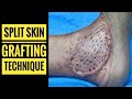 Split Thickness Skin Graft Technique