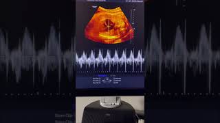 Baby’s heart beat #pregnancy #ultrasound #radiology #pregnancyjourney #motherhood #health #mbbs