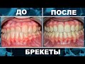 Брекеты до и после. Исправление прикуса за 14 месяцев.