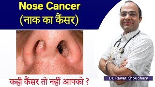 Nose Cancer | नाक का कैंसर | Best Treatment of Cancer | Best Homeopathic Treatment