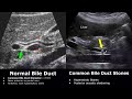 Bile Duct Ultrasound Normal Vs Abnormal Image Appearances | Biliary Tract Abnormalities USG Scan