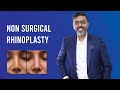 Non-Surgical Rhinoplasty - Treatment, Results, Benefits & Cost By Dr. Sunil Richardson