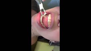 How Braces are removed (Orthodontics cases)