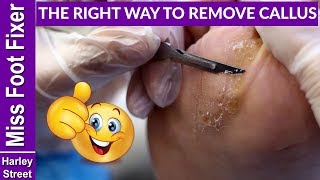 The right way to remove callus and corns - FULL TREATMENT