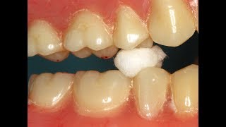 The Chew Test - Diagnosing & Adjusting Denture Occlusion