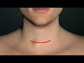 هذا هو سرطان الغدة الدرقية في الحقيقة_عافانا الله واياكم وانتبة لهذة الاعراض thyroid cancer