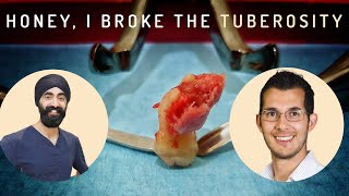 How To Manage a Maxillary Tuberosity Fracture - Oral Surgery Complications