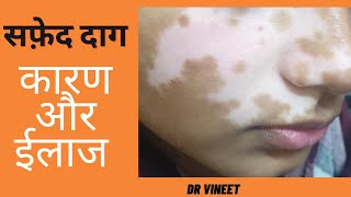 सफ़ेद दाग - कारण और उपचार | Vitiligo- Causes & Treatment |Dr Vineet | VR Skin Clinic |Bikaner