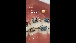 Braces Wire Poking Lips And IT HURTS SO BAD!!! 😩 Orthodontist Reacts…