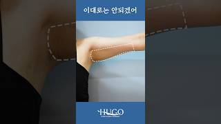 Forearm liposuction day 7 review