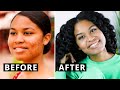 How I Healed My Acne with a Whole Food Plant-Based Diet (STEP BY STEP)