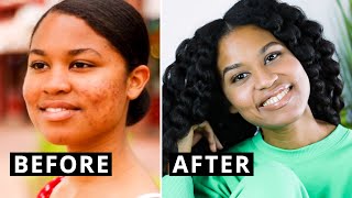 How I Healed My Acne with a Whole Food Plant-Based Diet (STEP BY STEP)